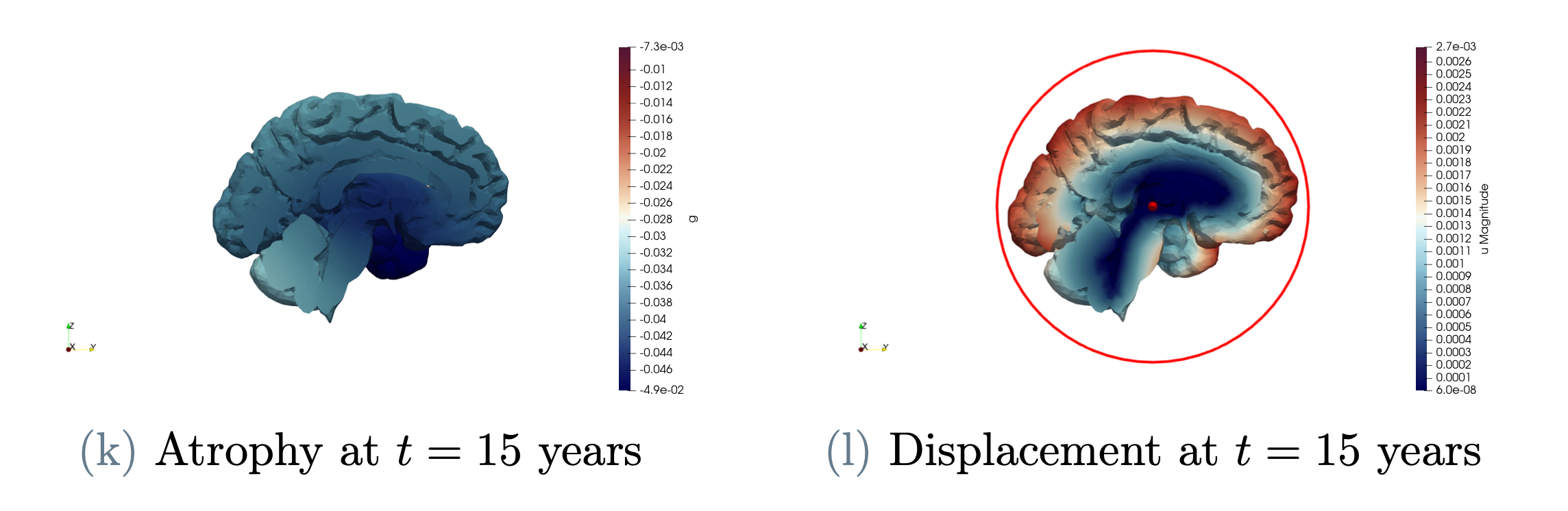 A mathematical model of brain atrophy in Alzheimer’s disease, Valentina Pederzoli, 2024. Advisor: Prof. Paola F. Antonietti, Co-Advisor: M. Corti, D: Riccobelli